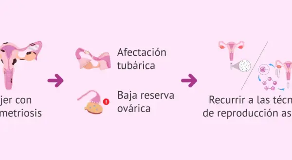 Ilustración muestra cómo la endometriosis puede afectar las trompas y ovarios, llevando a la necesidad de técnicas de reproducción asistida para el embarazo.