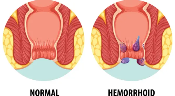 Hemoroidy: Do jakiego lekarza iść? Pełny przewodnik po leczeniu
