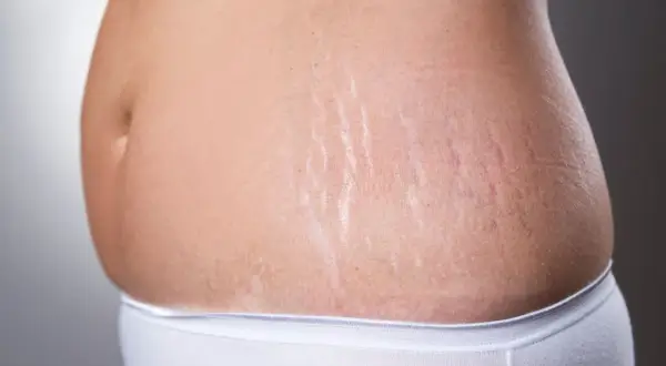Bauch einer Frau mit Dehnungsstreifen, ein Zeichen der zweiten Schwangerschaft.