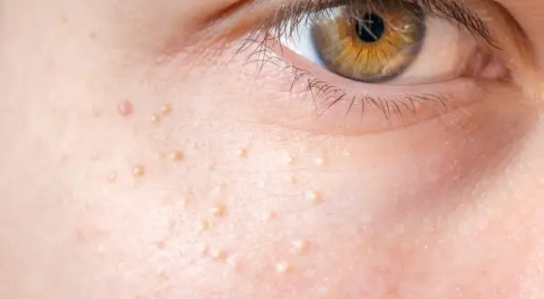 Nahaufnahme der Haut neben einem Auge mit vielen kleinen, hellen Erhebungen. Diese Hautunreinheiten sind nicht komedogen und stören die natürliche Ausstrahlung nicht.