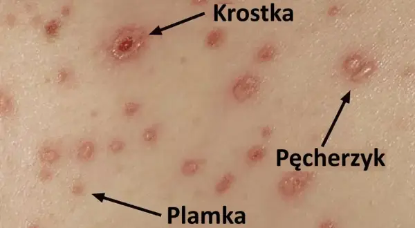 Skóra z licznymi zmianami: plamkami, krostkami i pęcherzykami. To po dniu ospa początki.