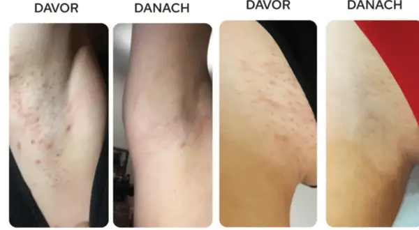 Vorher/Nachher-Bilder zeigen Achseln mit Rötungen und Pickeln nach der Rasur. Nach der Anwendung von Tipps zur Rasur sind die Achseln glatter und reizfreier.