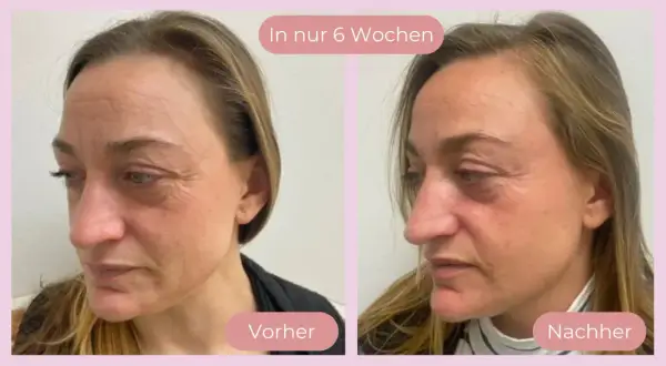 Vorher-Nachher-Vergleich: Hautbild einer Frau vor und nach 6 Wochen Behandlung. Deutliche Reduzierung von Falten, die Haut wirkt straffer. Kollagen-Effekt sichtbar.