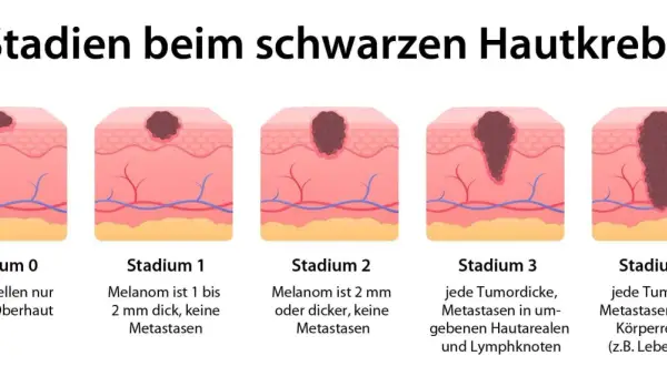 Illustration zeigt Stadien von schwarzem Hautkrebs. Symptome reichen von frühen Tumoren in der Oberhaut bis zu Metastasen in entfernten Körperregionen.