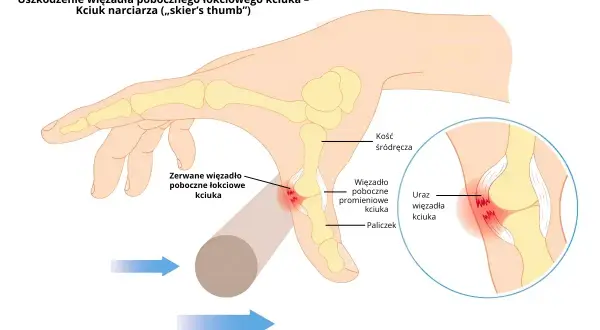Ilustracja anatomiczna kciuka z zaznaczonym zerwanym więzadłem pobocznym łokciowym.