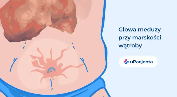 Ilustracja przedstawia brzuch z widoczną, uszkodzoną wątrobą i pajęczakiem naczyniowym. To objawy, które mogą świadczyć o tym, że wyleczyłem marskość wątroby.