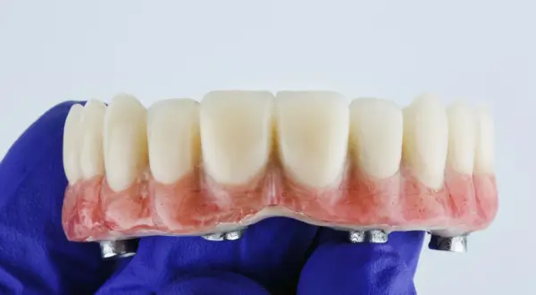 Proteza zębowa na implantach, wykonana w ramach NFZ. Sztuczne zęby z różową podstawą, trzymane w niebieskiej rękawiczce.