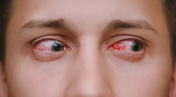 Ojos rojos e irritados, señal de que la conjuntivitis es contagiosa.