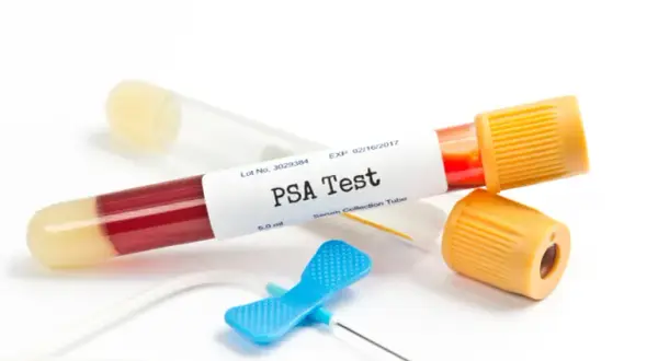 PSA co to za badanie? Kluczowe informacje o zdrowiu prostaty