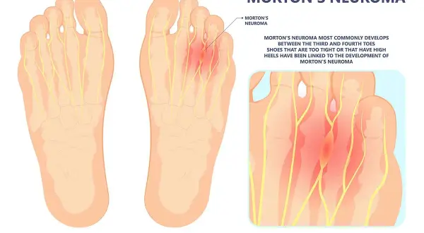 Illustration zeigt gesunde Fußsohle und Morton-Neurom. Selbsthilfe bei Morton-Neurom durch passende Schuhe ist wichtig.