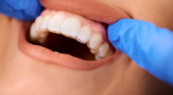 Dentyści w niebieskich rękawiczkach poprawiają przezroczysty aparat ortodontyczny, korygując zgryz otwarty.