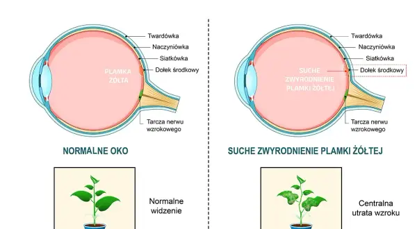 Porównanie budowy oka z metamorfopsjami. Po lewej zdrowe oko i normalne widzenie rośliny. Po prawej suche zwyrodnienie plamki żółtej i widzenie z centralną utratą wzroku.