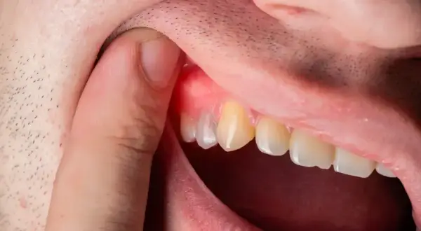 Co wyciąga ropę z zęba? Tylko dentysta! Ulga i ratunek