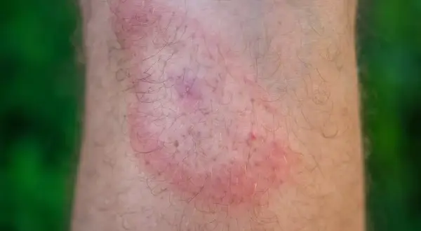 Rote, juckende Stelle am Bein nach einem Zeckenbiss. Wann zum Arzt? Informieren Sie sich über Symptome und Behandlung.