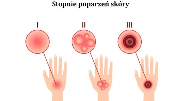 Ilustracja pokazuje stopnie poparzeń skóry: I stopień to zaczerwienienie, II stopień to bąble po oparzeniu słonecznym, a III stopień to głębokie uszkodzenie.