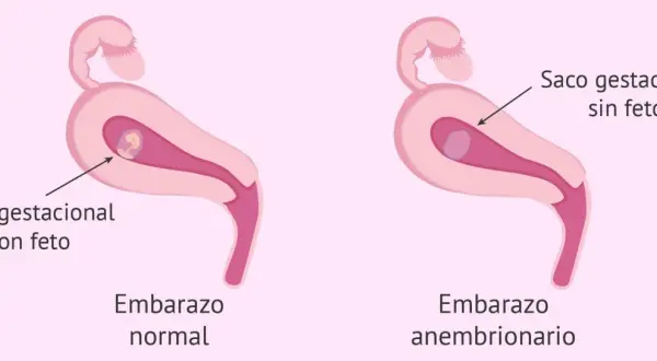 Ilustración comparativa de un embarazo normal con saco gestacional y feto, y un embarazo anembrionario con saco gestacional sin feto. Experiencias de embarazo anembrionario.