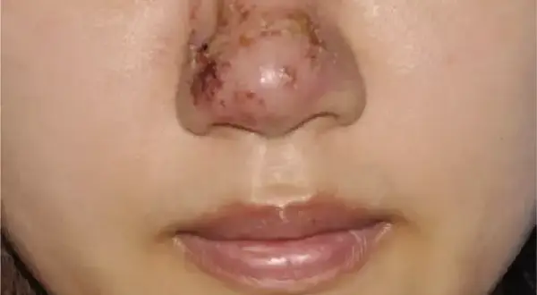 Biofilm po kwasie hialuronowym objawy: jak uniknąć powikłań?