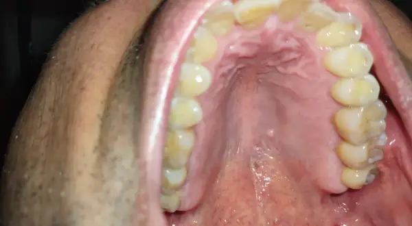 Vista ravvicinata della bocca con denti ingialliti e una piccola cisti sul palato.