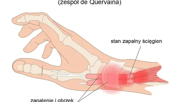 Ilustracja anatomiczna dłoni z zaznaczonym zapaleniem pochewek ścięgnistych kciuka.