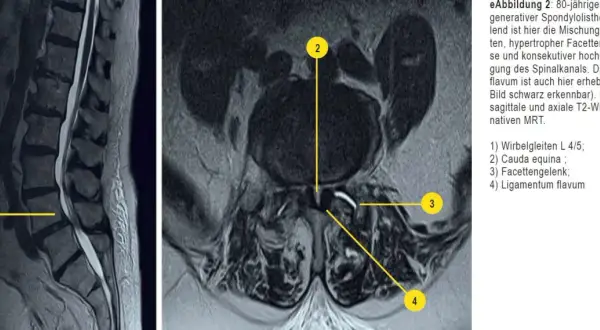 MRT-Aufnahmen der Lendenwirbelsäule zeigen eine Spondylolisthese L4/5, die auf Osteochondrose LWS hindeutet. Verdicktes Ligamentum flavum verengt den Spinalkanal.