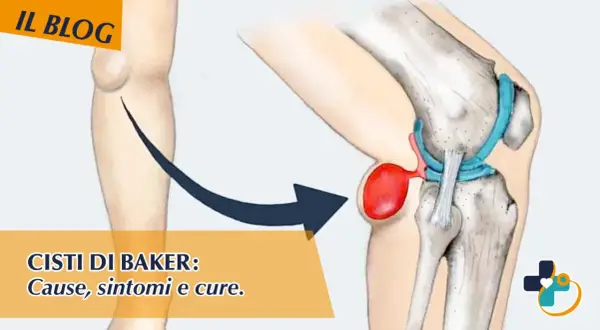 Illustrazione anatomica del ginocchio che mostra una cisti di Baker. Scopri come sfiammare cisti di Baker, cause, sintomi e cure.