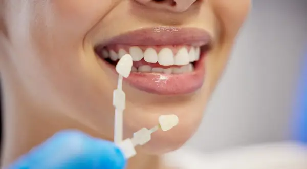 Dobór koloru licówek do naturalnych zębów. Na ile zębów zakłada się licówki? Decyzja należy do pacjenta i dentysty.