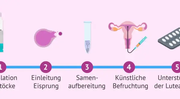 Der Insemination Ablauf: Stimulation der Eierstöcke, Eisprung-Einleitung, Samenvorbereitung, künstliche Befruchtung, Lutealphase-Unterstützung.
