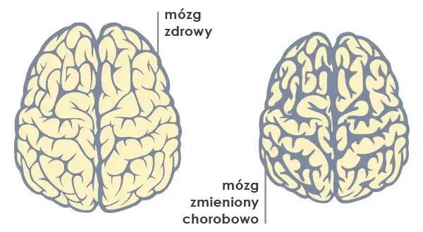 Demencja to choroba mózgu, nie psychiczna. Wyjaśniamy różnice.