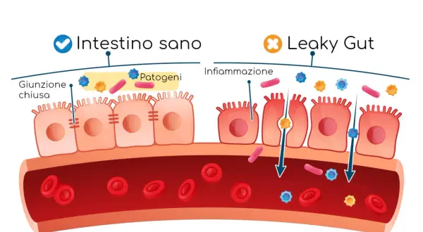Intestino sano con giunzione chiusa e patogeni bloccati. Leaky gut con infiammazione, dove i patogeni attraversano la barriera intestinale.