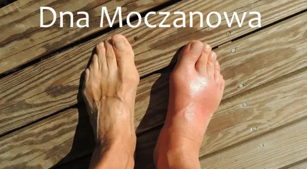 Dwa stopy na drewnianym tarasie. Prawy stopa jest zaczerwieniona i opuchnięta, co sugeruje podagrę.
