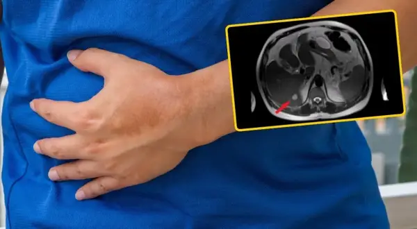 Osoba trzyma się za brzuch, obok obraz rezonansu magnetycznego wątroby z zaznaczoną zmianą. Czy wątroba się regeneruje?