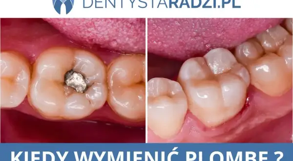 Przed i po leczeniu próchnicy: stary, metalowy wypełnienie zęba zastąpione nowym, estetycznym.