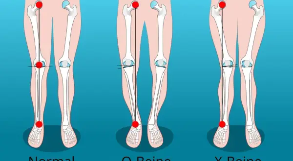 Vergleich von normalen Beinen, O-Beinen und X-Beinen. Die Darstellung zeigt die Knochenstruktur und die Ausrichtung der Gliedmaßen.