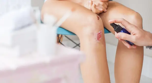 Jemand desinfiziert eine aufgeschürfte Wunde am Knie mit einem Spray.