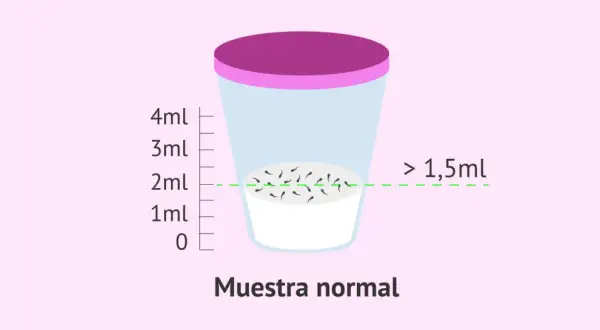 Recipiente con muestra de semen, indicando que la cantidad normal de espermatozoides en una eyaculación es mayor a 1,5ml.
