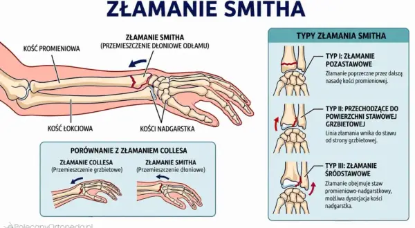 Ilustracja przedstawia złamanie z przemieszczeniem kości promieniowej, zwane złamaniem Smitha, z uwzględnieniem typów i porównaniem ze złamaniem Collesa.