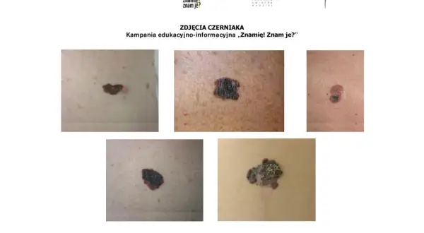 Różne rodzaje znamion i czerniaków. Kampania edukacyjna "Znamię! Znam je?".