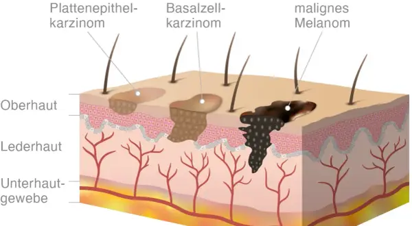 Vergleich von weißem Hautkrebs (Plattenepithelkarzinom, Basalzellkarzinom) und schwarzem Hautkrebs (malignes Melanom). Welcher Hautkrebs ist schlimmer? Das Melanom ist aggressiver.