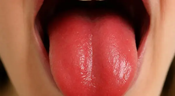 Lingua rossa e liscia, possibile sintomo di carenza vitamina b12.