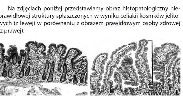 Celiakia jaki lekarz - jak nie popełnić błędu w diagnozie?