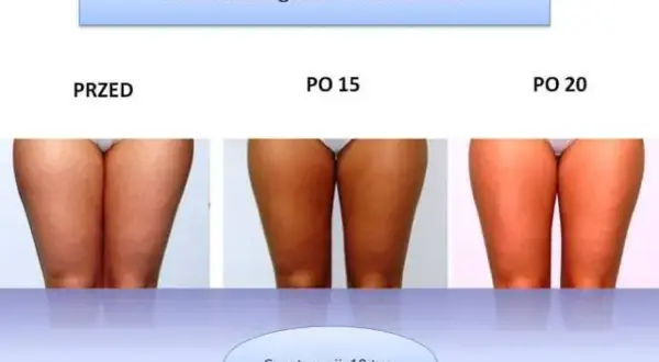 Endermologia: dla kogo? Kiedy warto, a kiedy unikać zabiegu?