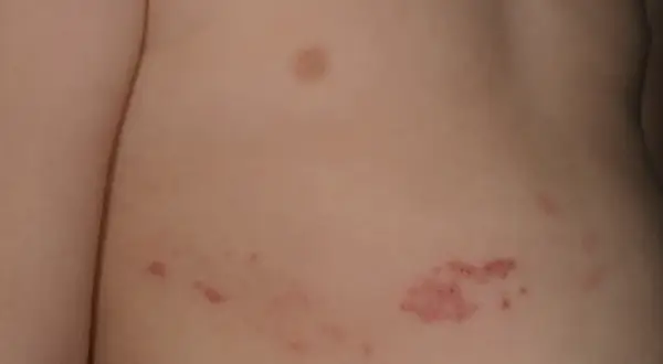 Barnets hud visar ett utslag med röda prickar och blåsor, troligen bältros.