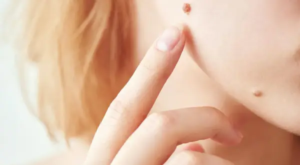 Ein Finger berührt ein Muttermal im Gesicht, das juckt. Daneben sind weitere Muttermale zu sehen.