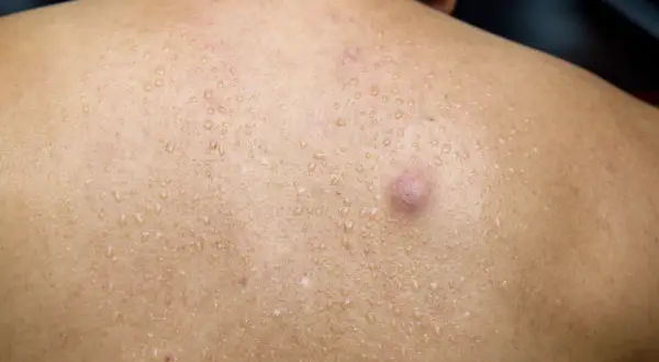 Widoczny pryszcz, czyli ropa pod skórą, na spoconych plecach.