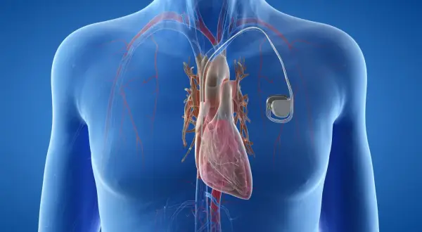Anatomical illustration of a human heart with a pacemaker. Warto wiedzieć, ile się czeka na wszczepienie rozrusznika serca.