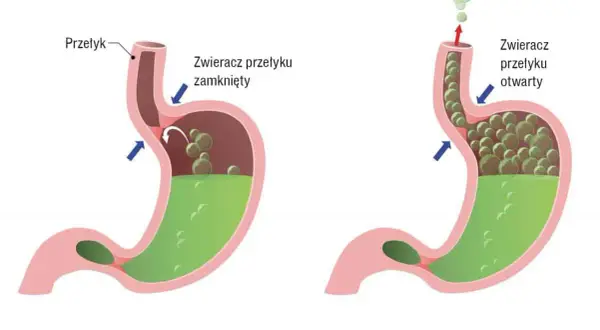 Zdrowy żołądek z zamkniętym zwieraczem przełyku vs. refluks, gdzie otwarty zwieracz pozwala treści żołądkowej cofnąć się do przełyku.