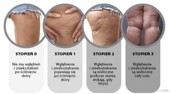 Cellulit na udach i pośladkach: skuteczne metody i zabiegi