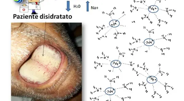Lingua: Italiano

Ipernatremia: paziente disidratato con lingua secca e patinata, indicativo di sodio alto. Le molecole di Na+ circondate da H2O illustrano la condizione.