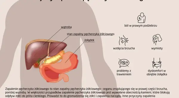 Ilustracja przedstawia anatomię jamy brzusznej z zaznaczonym zapaleniem pęcherzyka żółciowego. Wymienione objawy to ból, wzdęcia, wymioty i dyskomfort.