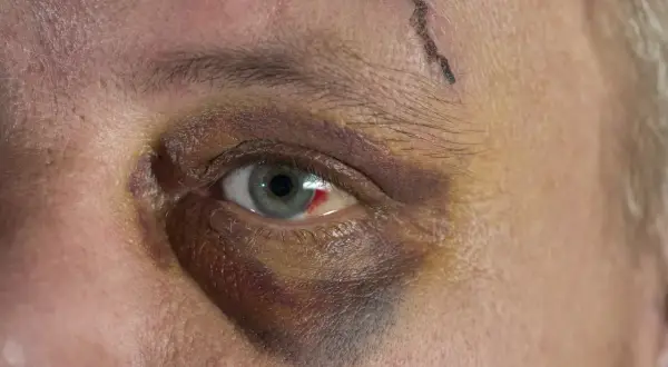 Ein blaues Auge mit einer kleinen Wunde auf der Stirn. Die Heilung dauert seine Zeit, aber das Auge wird wieder normal.